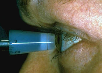 tonometer