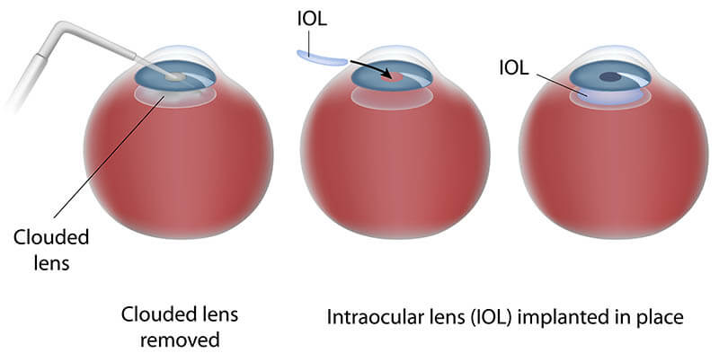 Chart Illustrating Laser Cataract Surgery
