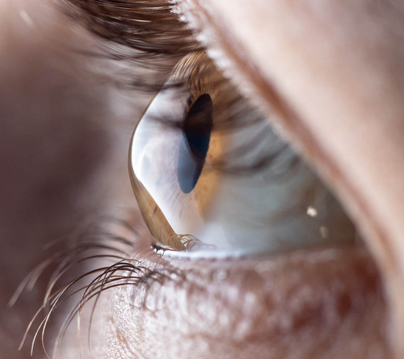 Closeup of an Eye With Keratoconus