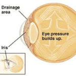 Glaucoma Diagram