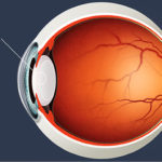 Cataract Diagram