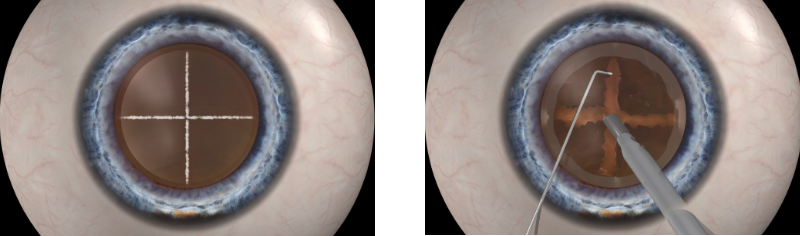 Laser fragmentation (left) is more precise and breaks up the lens with less ultrasound energy than manual fragmentation (right).