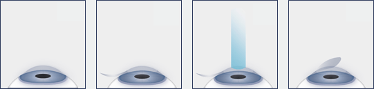 Chart Illustrating the LASIK Process